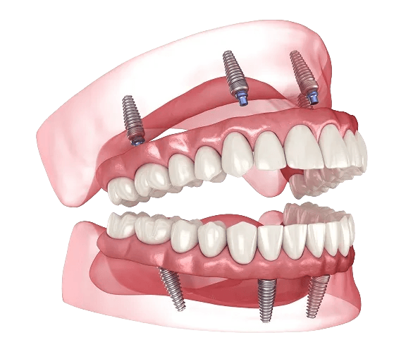 3D illustration of All-on-X fixed full arch dental implants