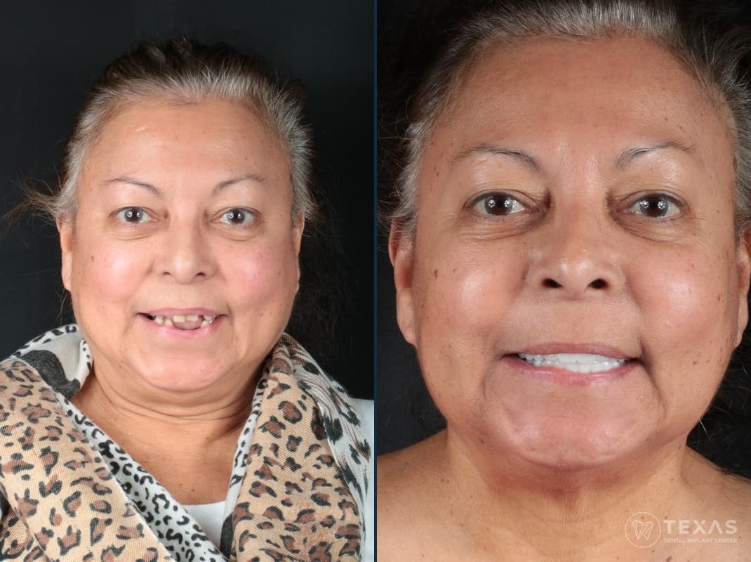 Before and after dental implant results - Patient 10 at Texas Dental Implant Center Houston