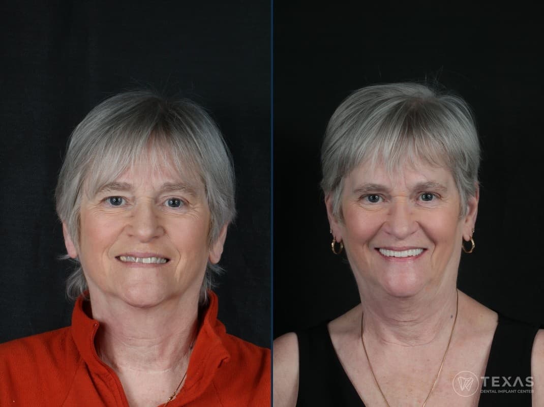 Before and after dental implant results - Patient 11 at Texas Dental Implant Center Houston