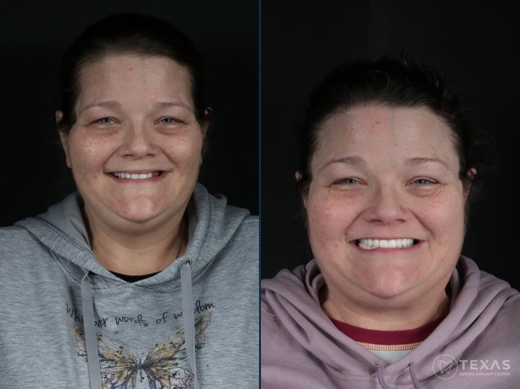 Before and after dental implant results - Patient 13 at Texas Dental Implant Center Houston
