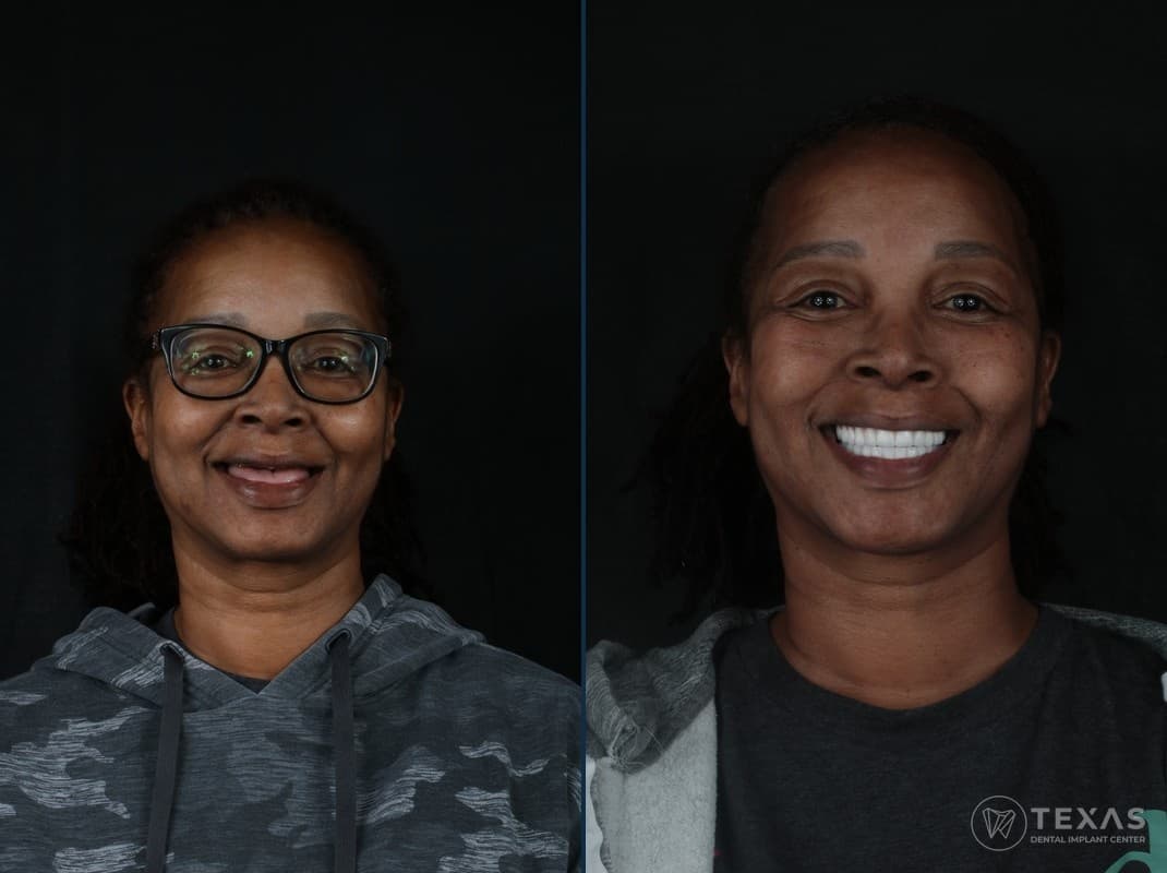 Before and after dental implant results - Patient 15 at Texas Dental Implant Center Houston