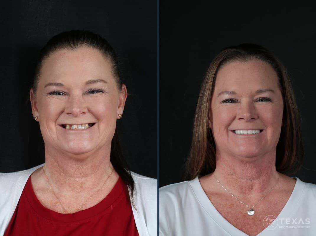 Before and after dental implant results - Patient 2 at Texas Dental Implant Center Houston