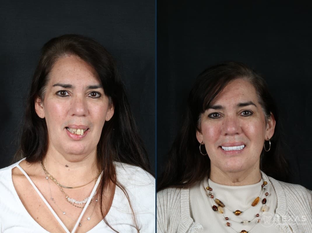 Before and after dental implant results - Patient 5 at Texas Dental Implant Center Houston