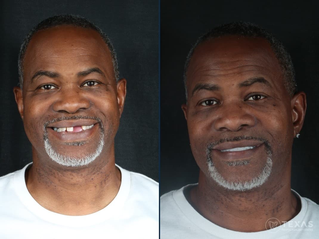 Before and after dental implant results - Patient 6 at Texas Dental Implant Center Houston