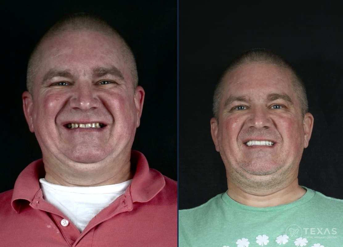 Before and after dental implant results - Patient 9 at Texas Dental Implant Center Houston