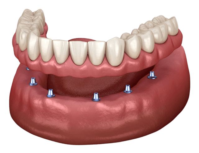 3D illustration of implant-supported snap-on denture