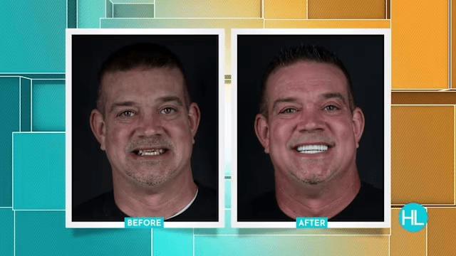 Houston Life: Smile Makeover Transformation Results