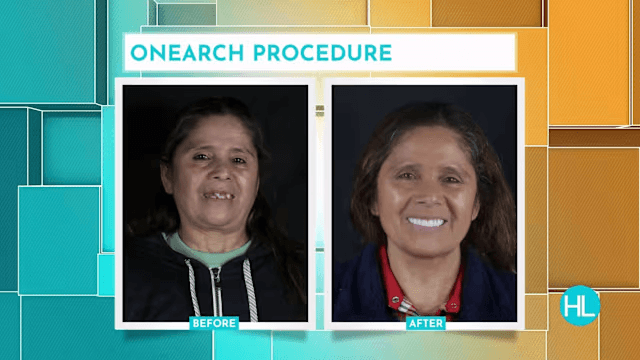 OneArch Procedure: Complete Smile Restoration