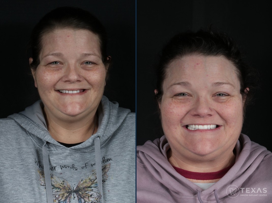 Before and after dental implant results - Patient 13 at Texas Dental Implant Center Houston