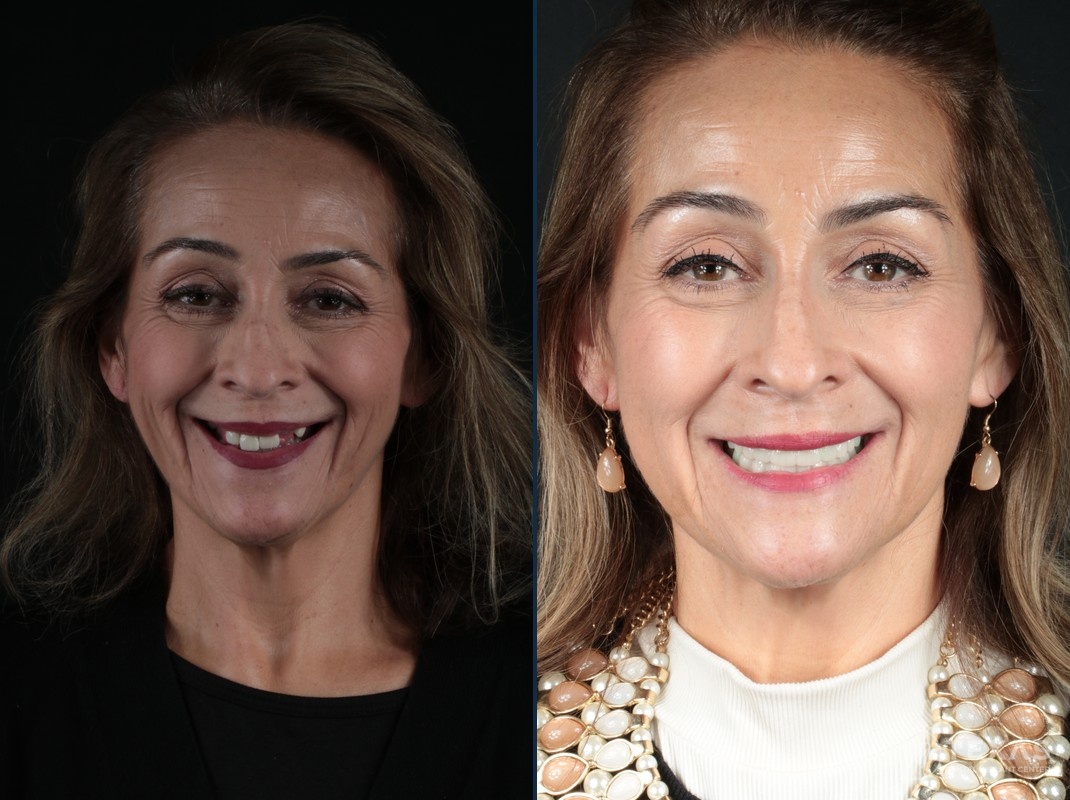 Before and after dental implant results - Patient 16 at Texas Dental Implant Center Houston