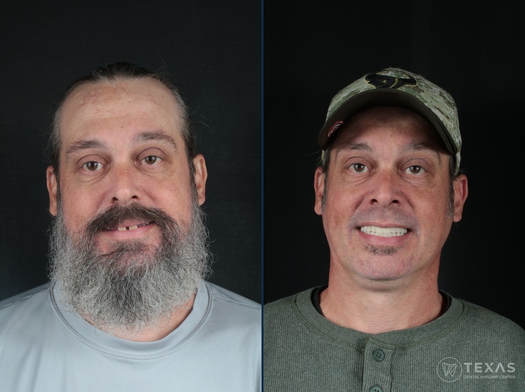 Before and after dental implant results - Patient 4 at Texas Dental Implant Center Houston