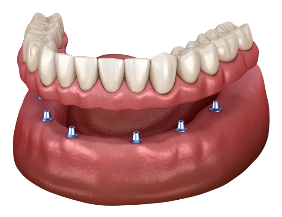 3D illustration of implant-supported snap-on denture