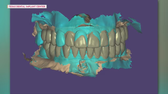 Advanced 3D Implant Planning Technology at TDIC