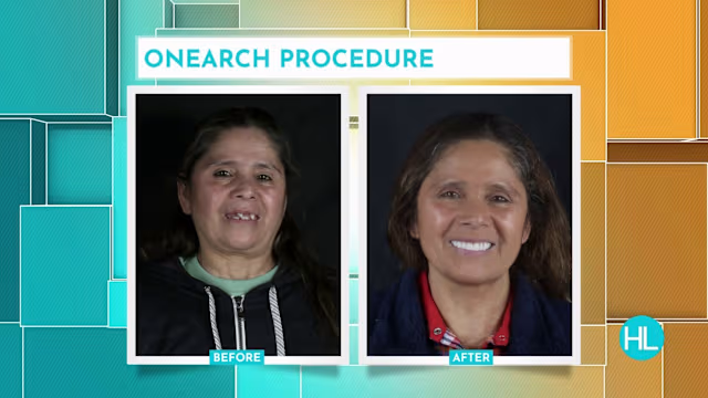 OneArch Procedure: Complete Smile Restoration