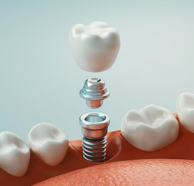 Dental implants