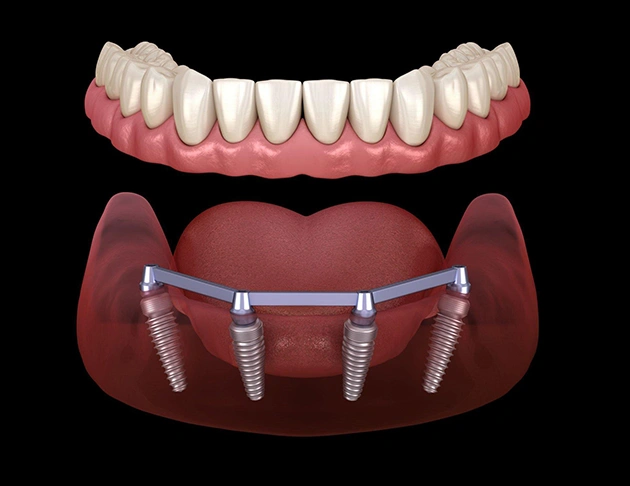 Dental implants