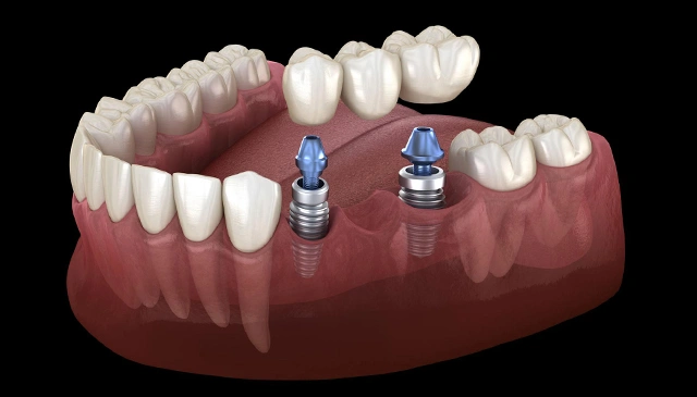 Single Tooth Implants & Multi-Tooth Bridges