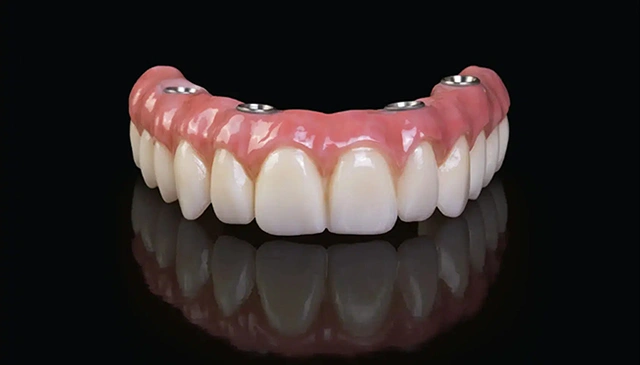 Snap-In Implant Dentures