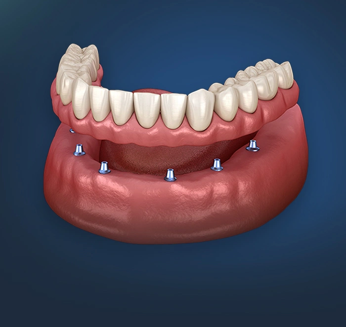 Snap in implant dentures