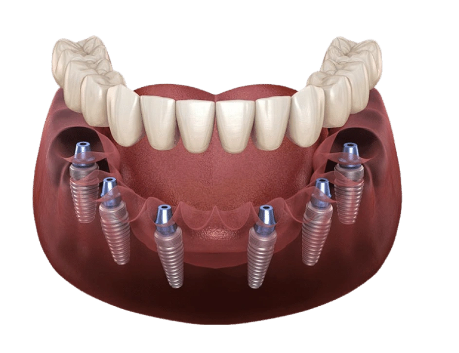 Conventional Implantology