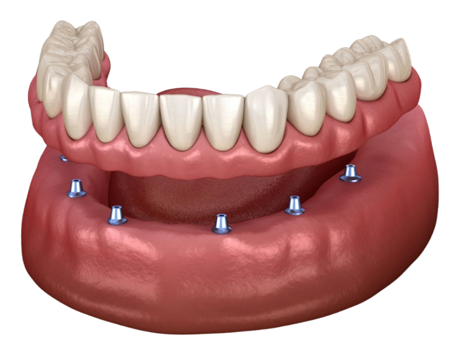 Snap on Overdenture