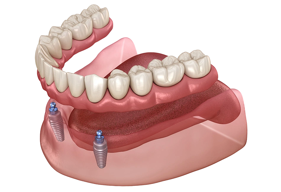 dental implants