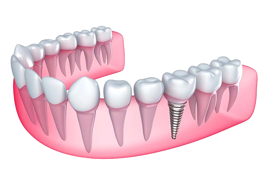 dental implants