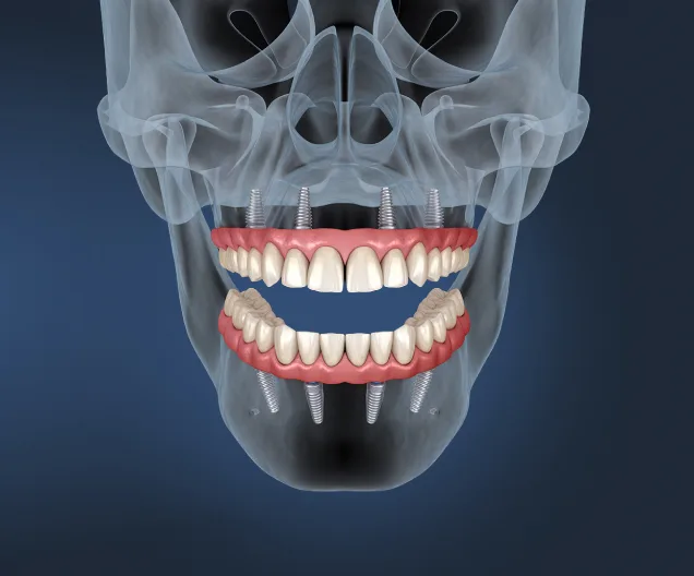 Zygomatic Implants