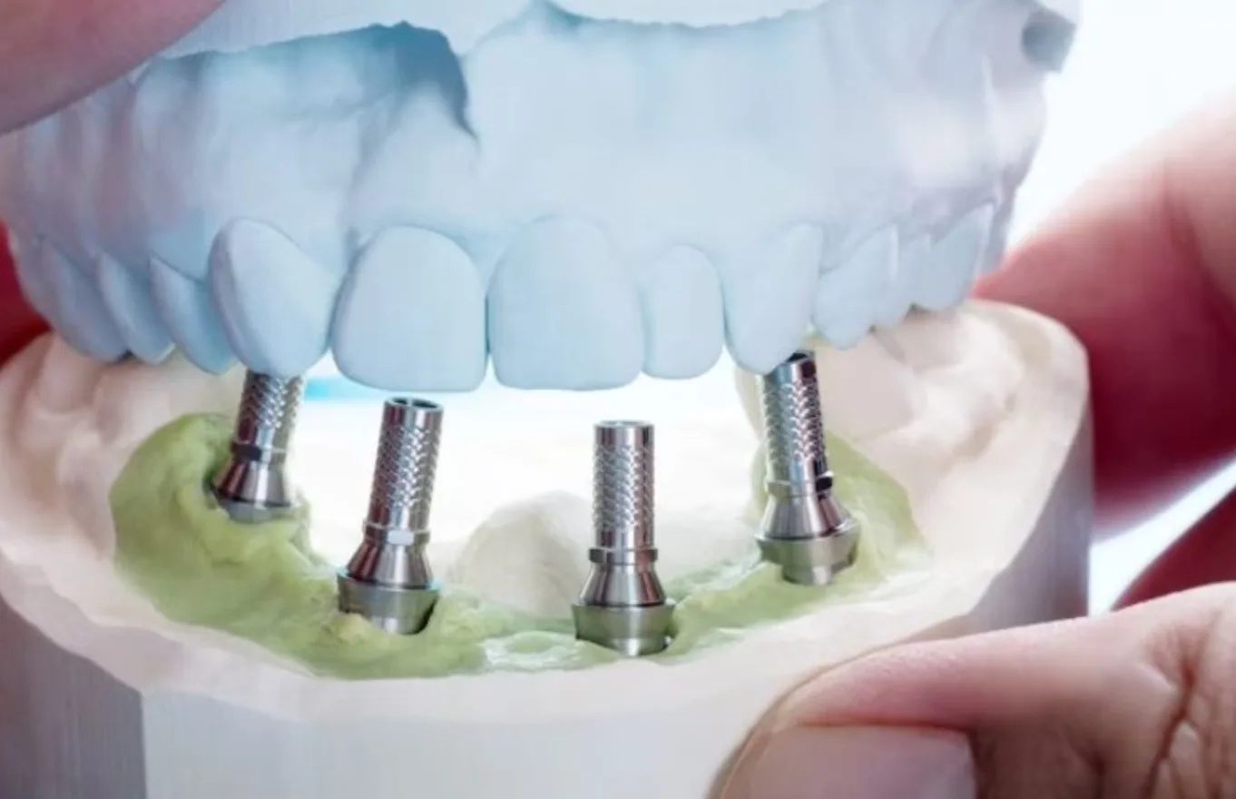 Know Everything About All-on-4 Dental Implants A Guide for Houston People